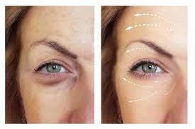 Mesotherapy Eye Treatment